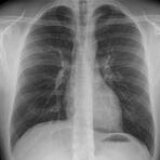 Röntgenaufnahme des Thorax